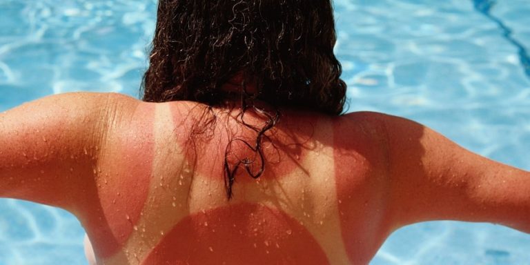 Home Remedies for Sunburn: 12 Methods That Have Actually Been Tested