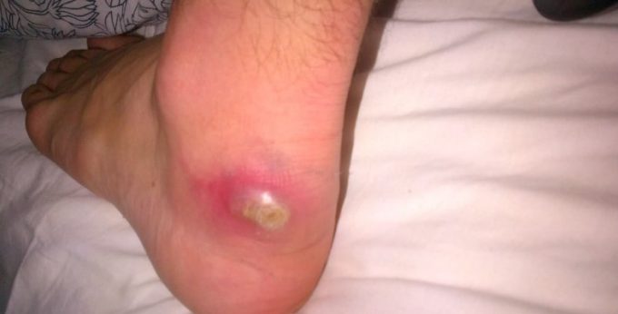 infected blister
